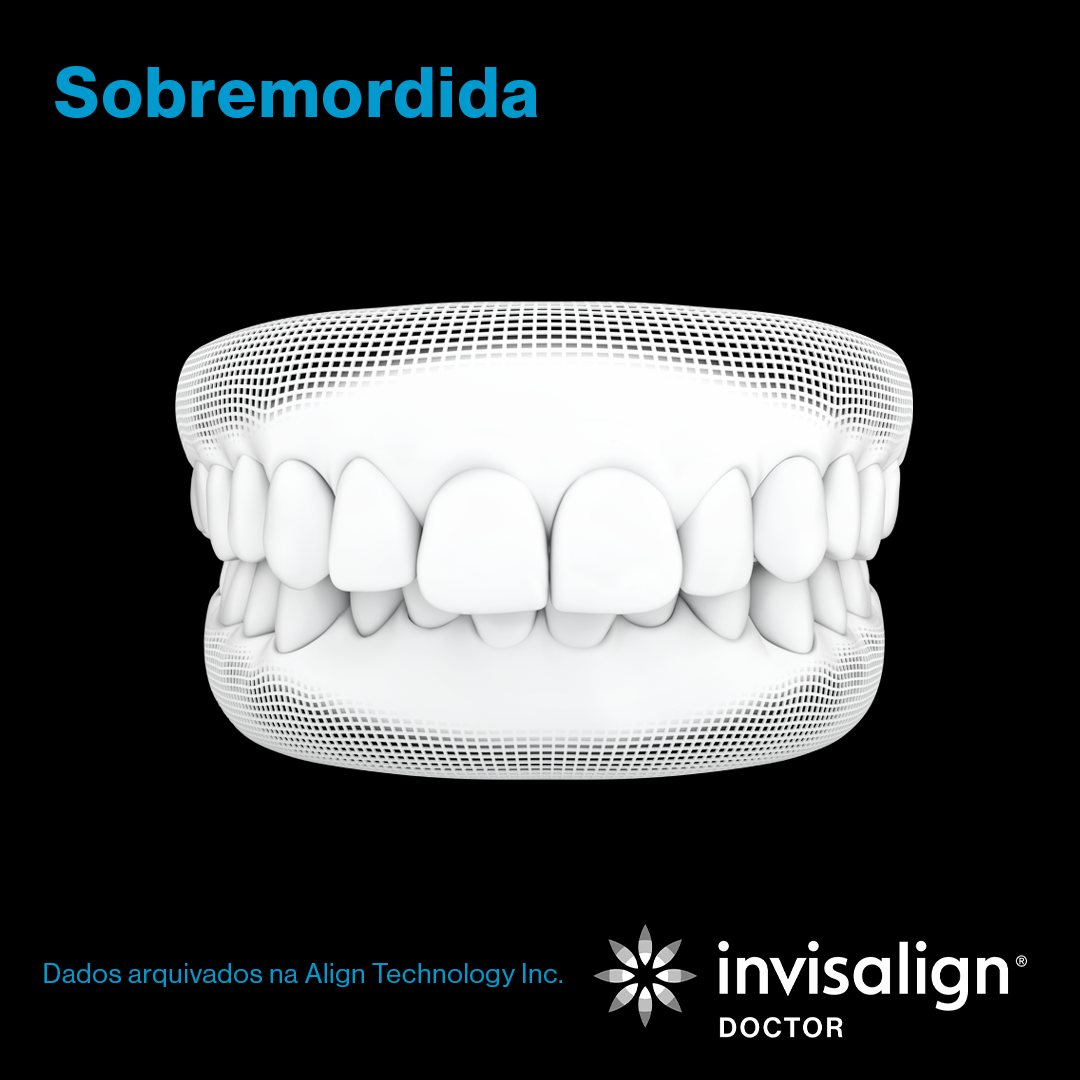 Invisalign_grade_nov_post01_gif_carrossel_POD_preto_1080x1080_2.png
