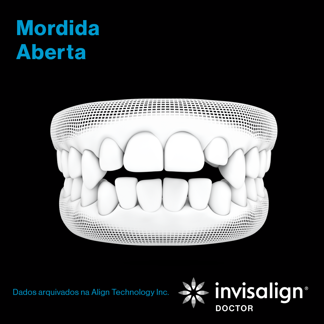 Invisalign_grade_nov_post01_gif_carrossel_POD_preto_1080x1080_6.png