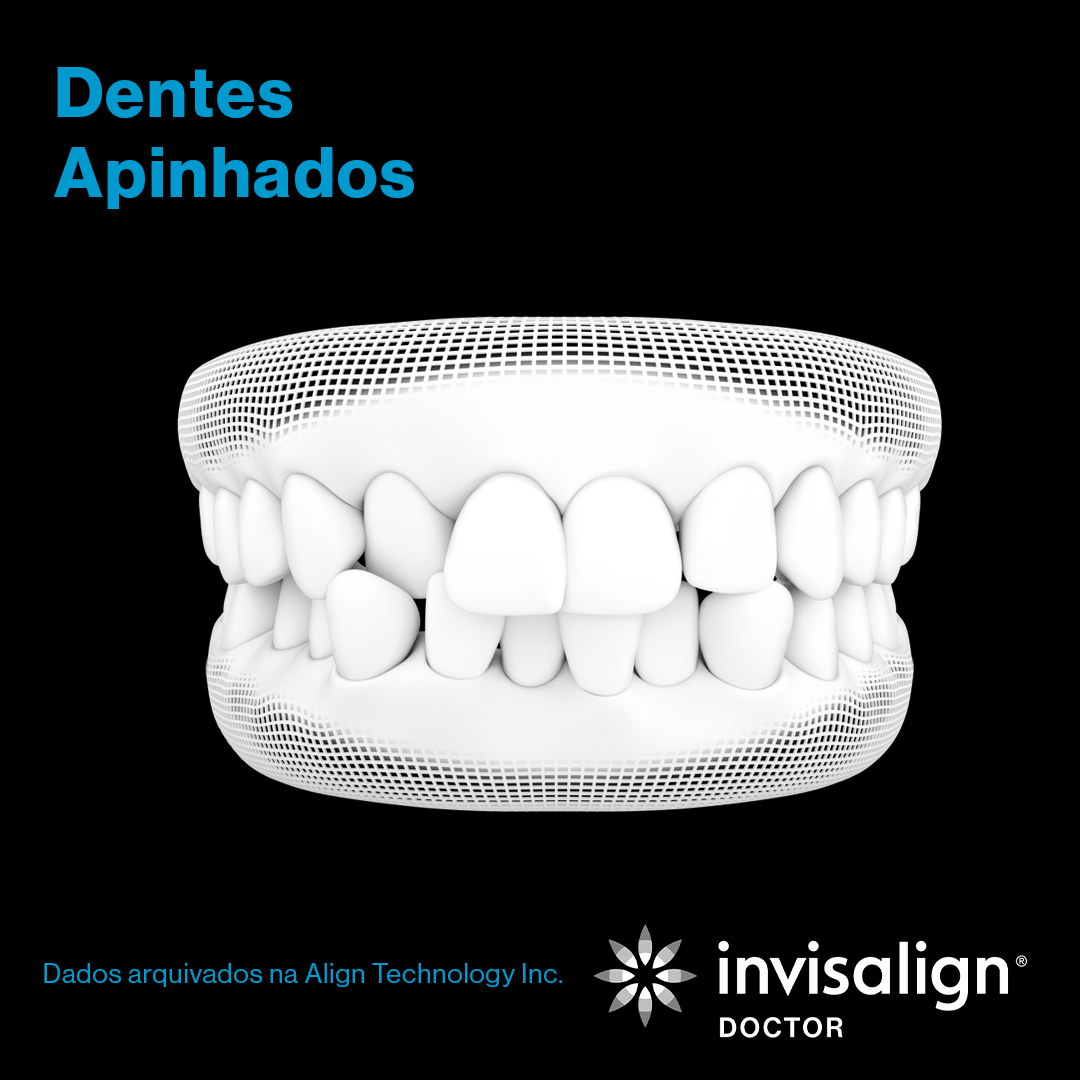 Invisalign_grade_nov_post01_gif_carrossel_POD_preto_1080x1080_7.png