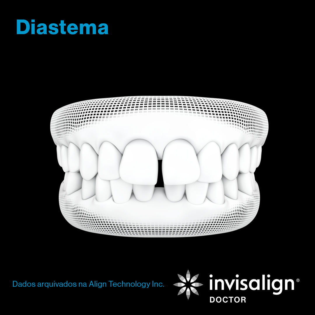 Invisalign_grade_nov_post01_gif_carrossel_POD_preto_1080x1080_5.png