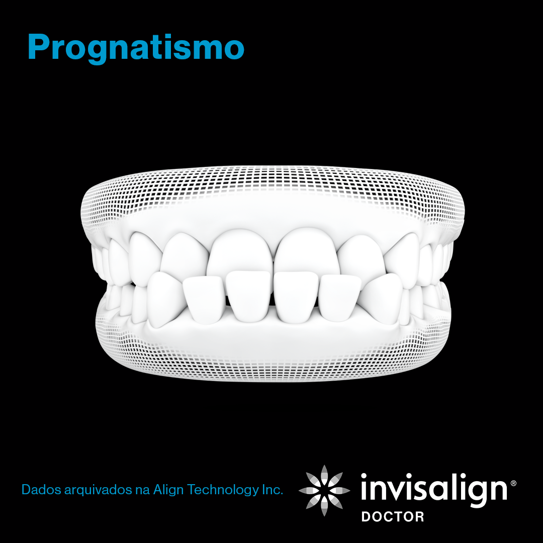 Invisalign_grade_nov_post01_gif_carrossel_POD_preto_1080x1080_3.png