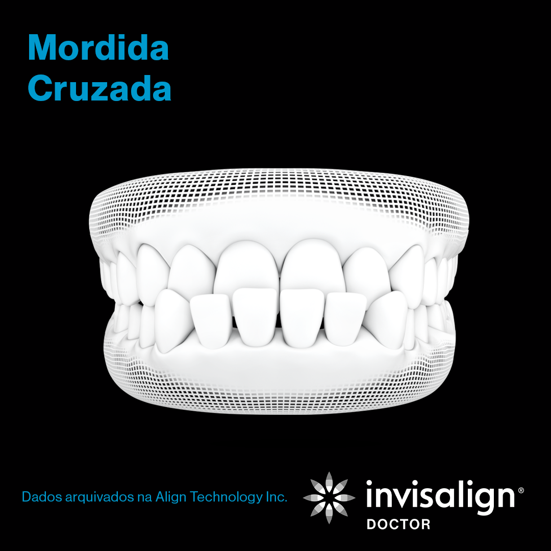 Invisalign_grade_nov_post01_gif_carrossel_POD_preto_1080x1080_4.png